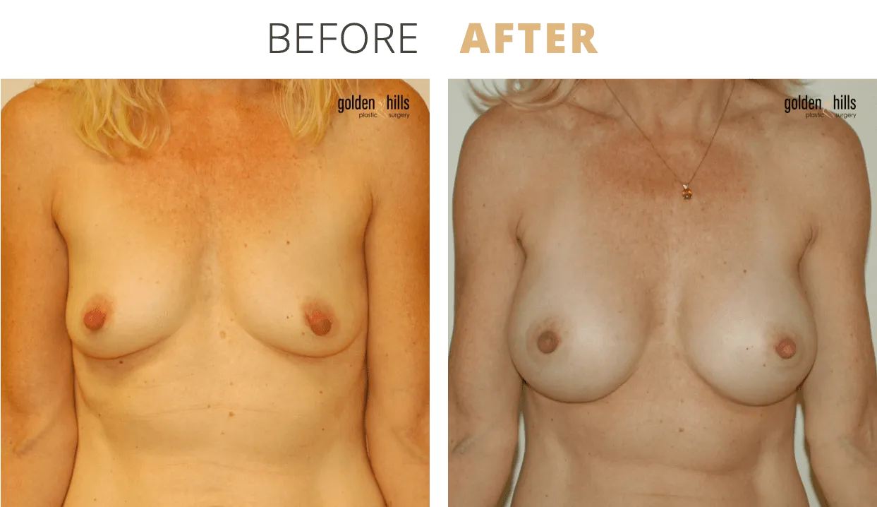 Breast-Breast+Augmentation7