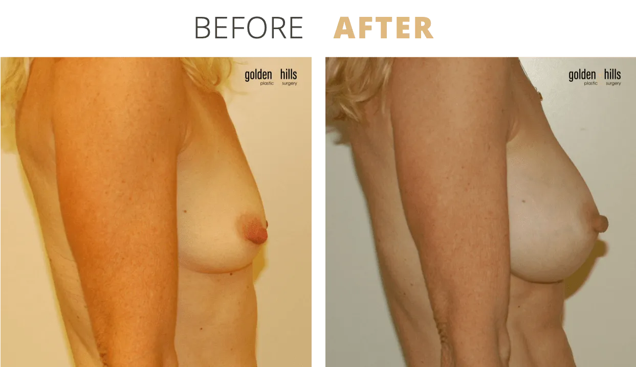 Breast-Breast+Augmentation8