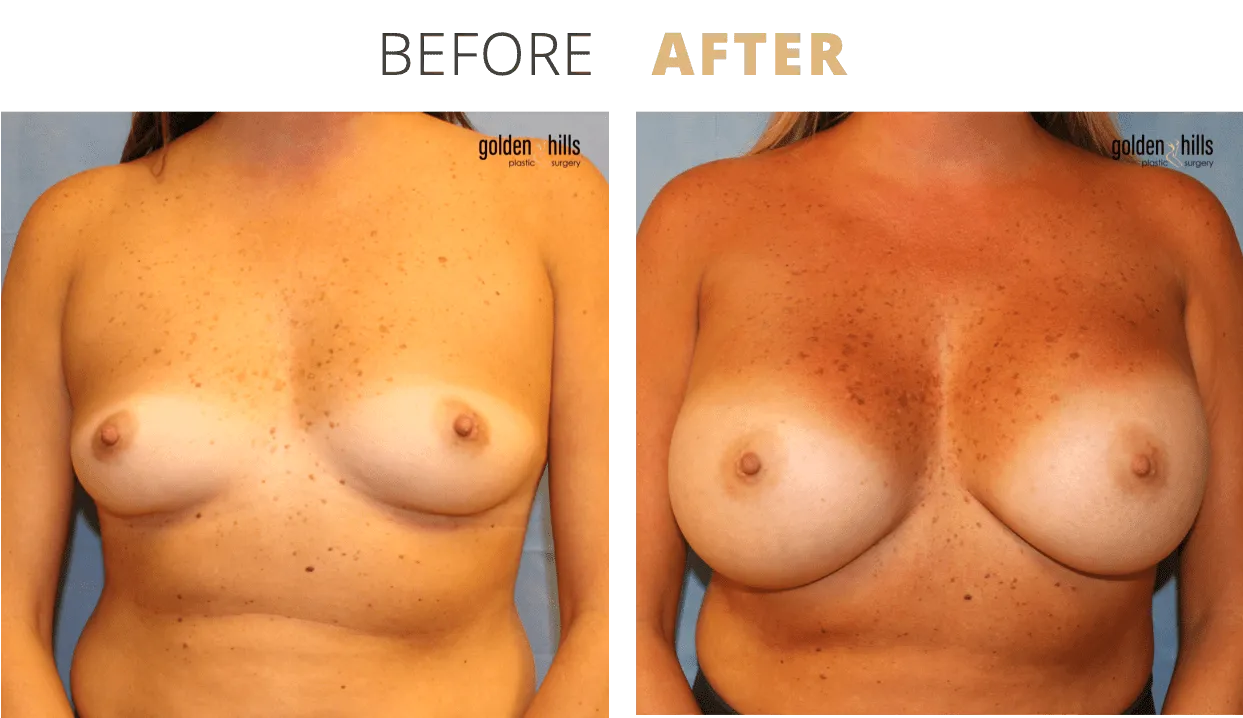 Breast-Breast+Augmentation9