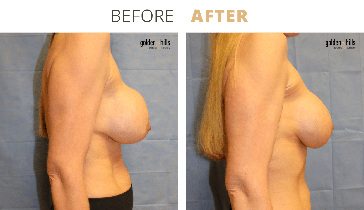 Breast-Revisional1
