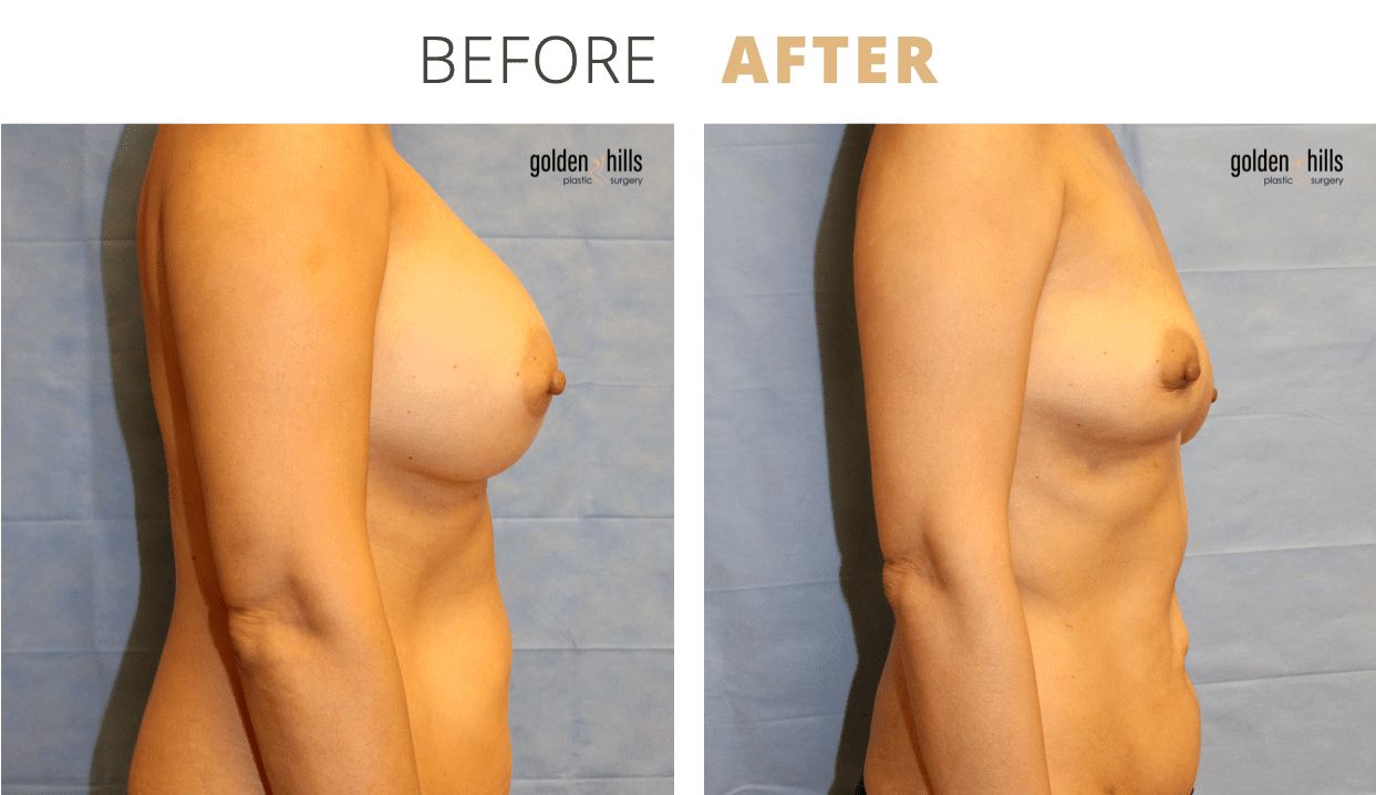 Breast-Revisional3
