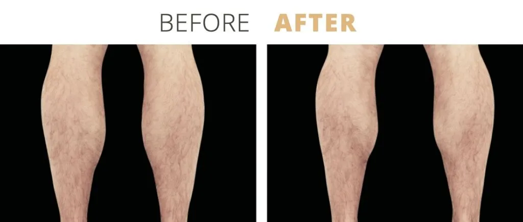 Emsculpt-Legs1