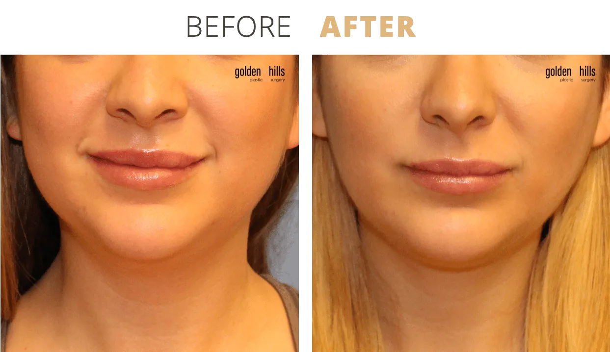 Face-Buccal+Fat+Pad+Removal1