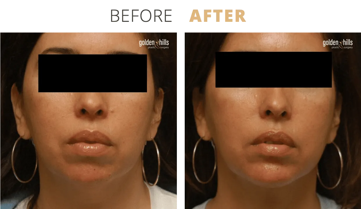 Face-Chin+Augmentation1