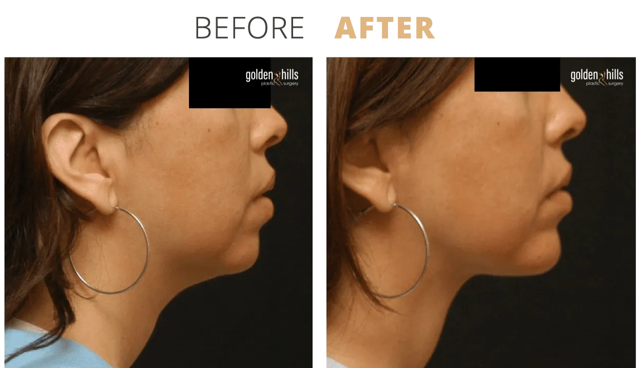 Face-Chin+Augmentation2
