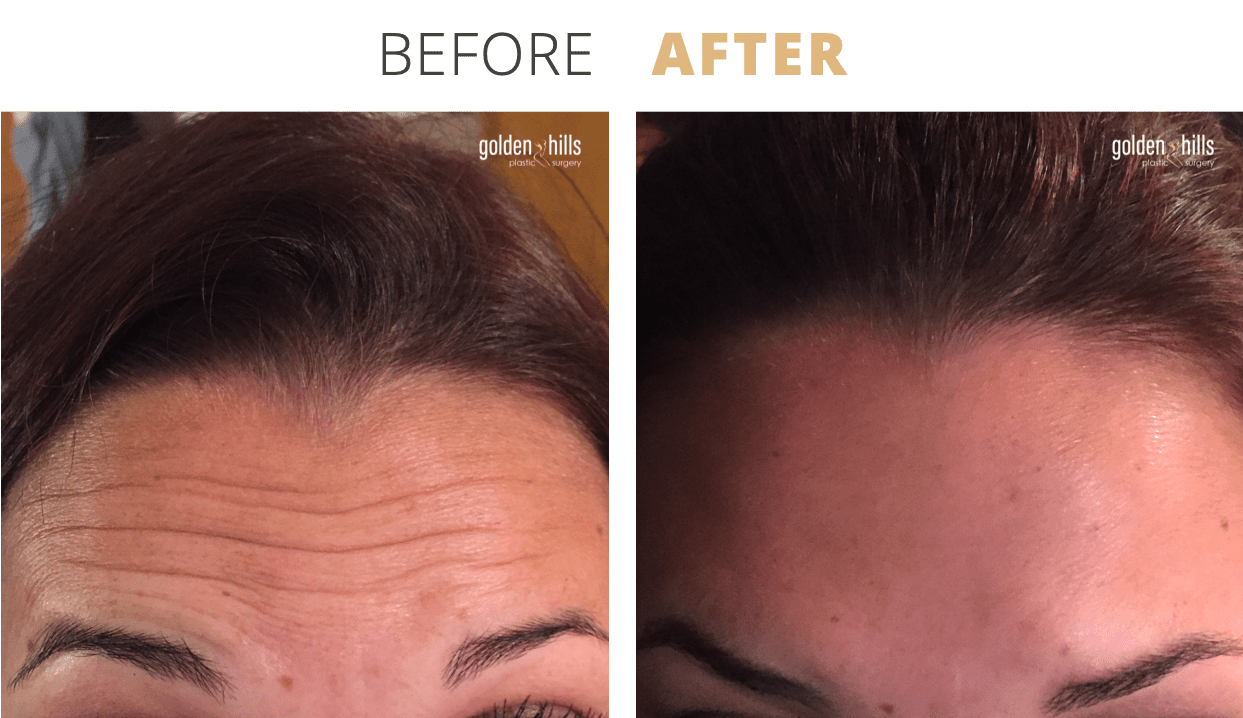 Injectables-Botox2 (1)