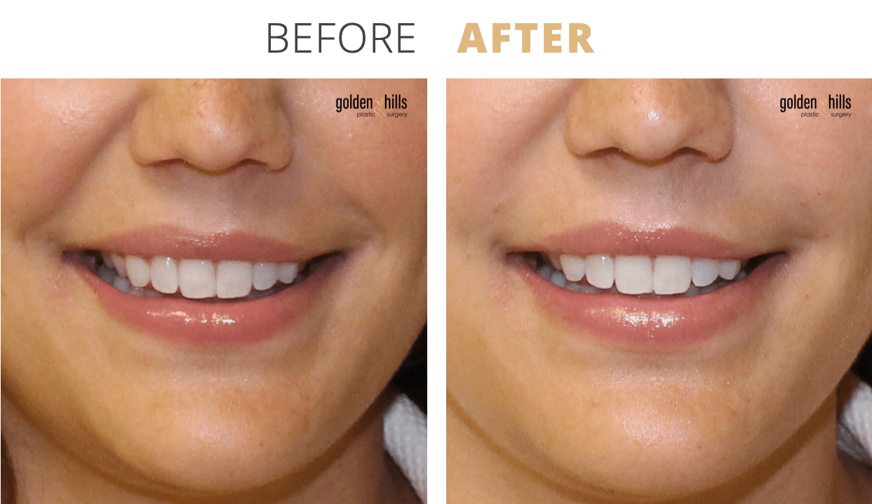 Injectables-Facial+Aging+Repair3