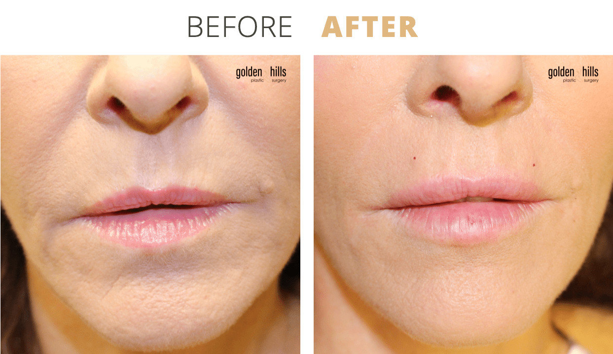 Injectables-Facial+Aging+Repair4