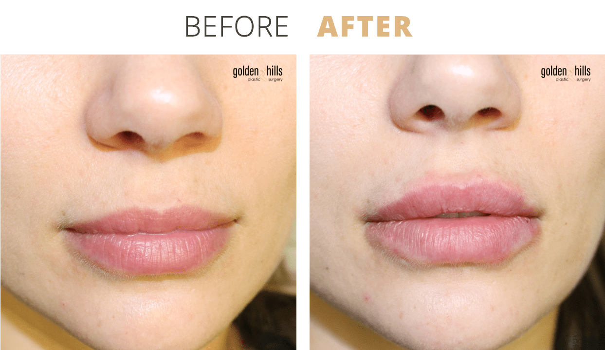 Injectables-Lip+Filler1