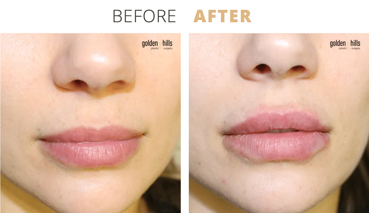 Injectables-Lip+Filler1