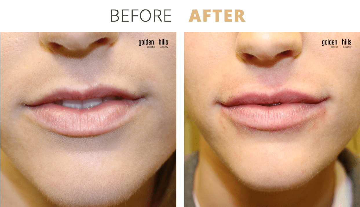 Injectables-Lip+Filler2