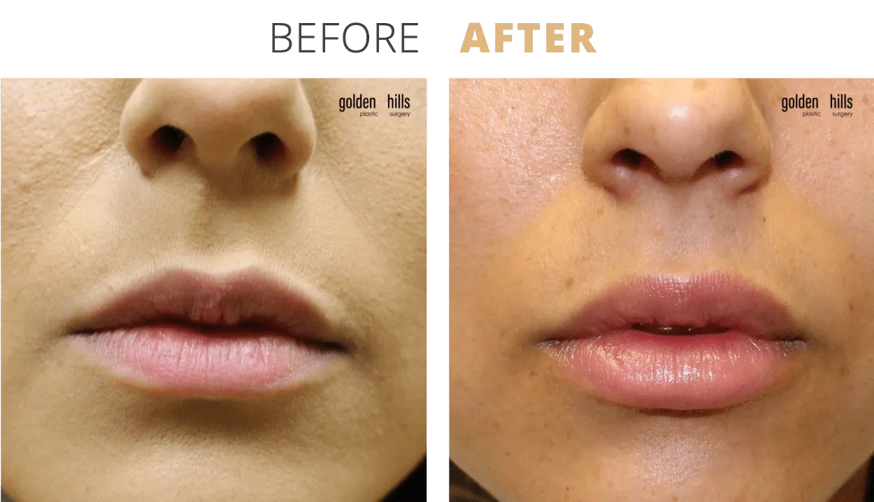 Injectables-Lip+Filler3