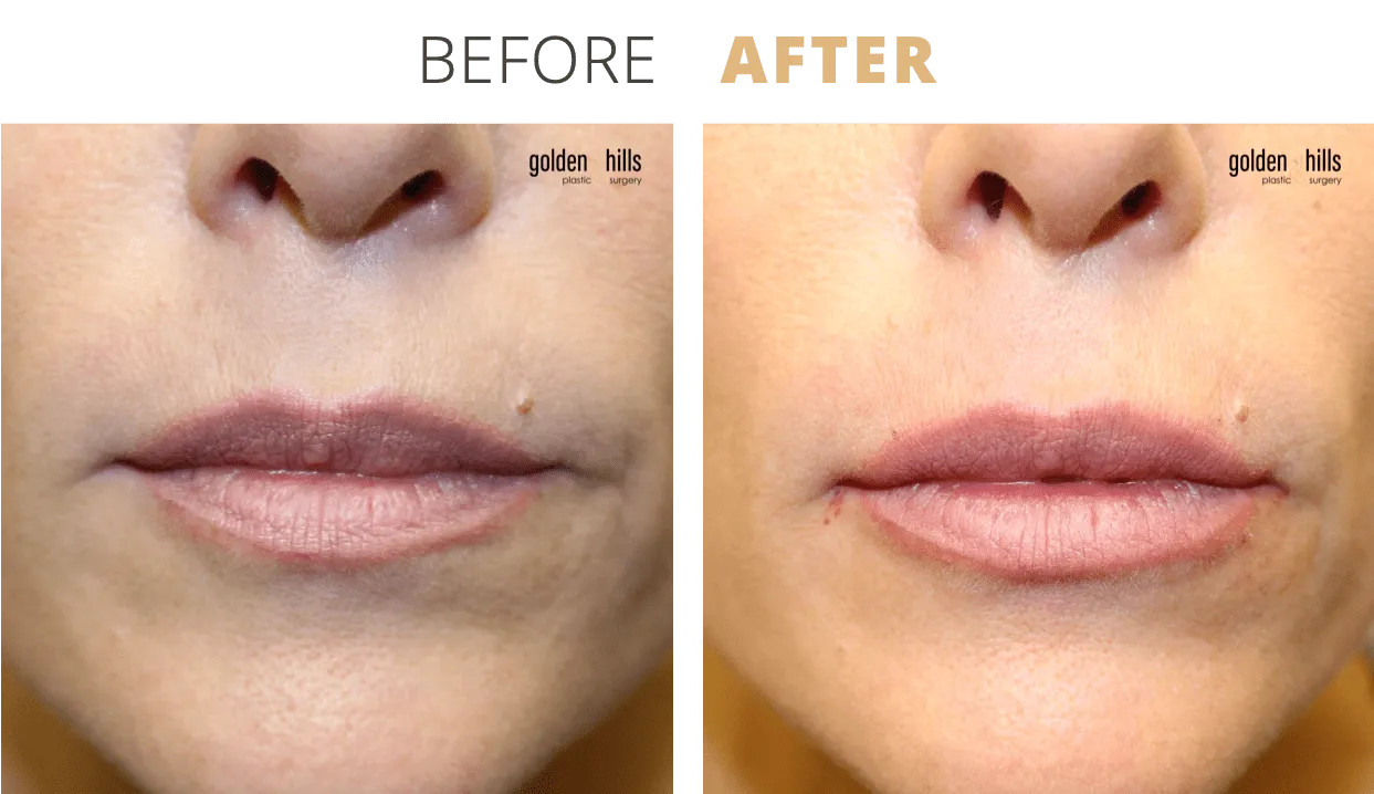 Injectables-Lip+Filler4