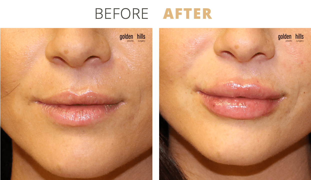 Injectables-Lip+Filler5