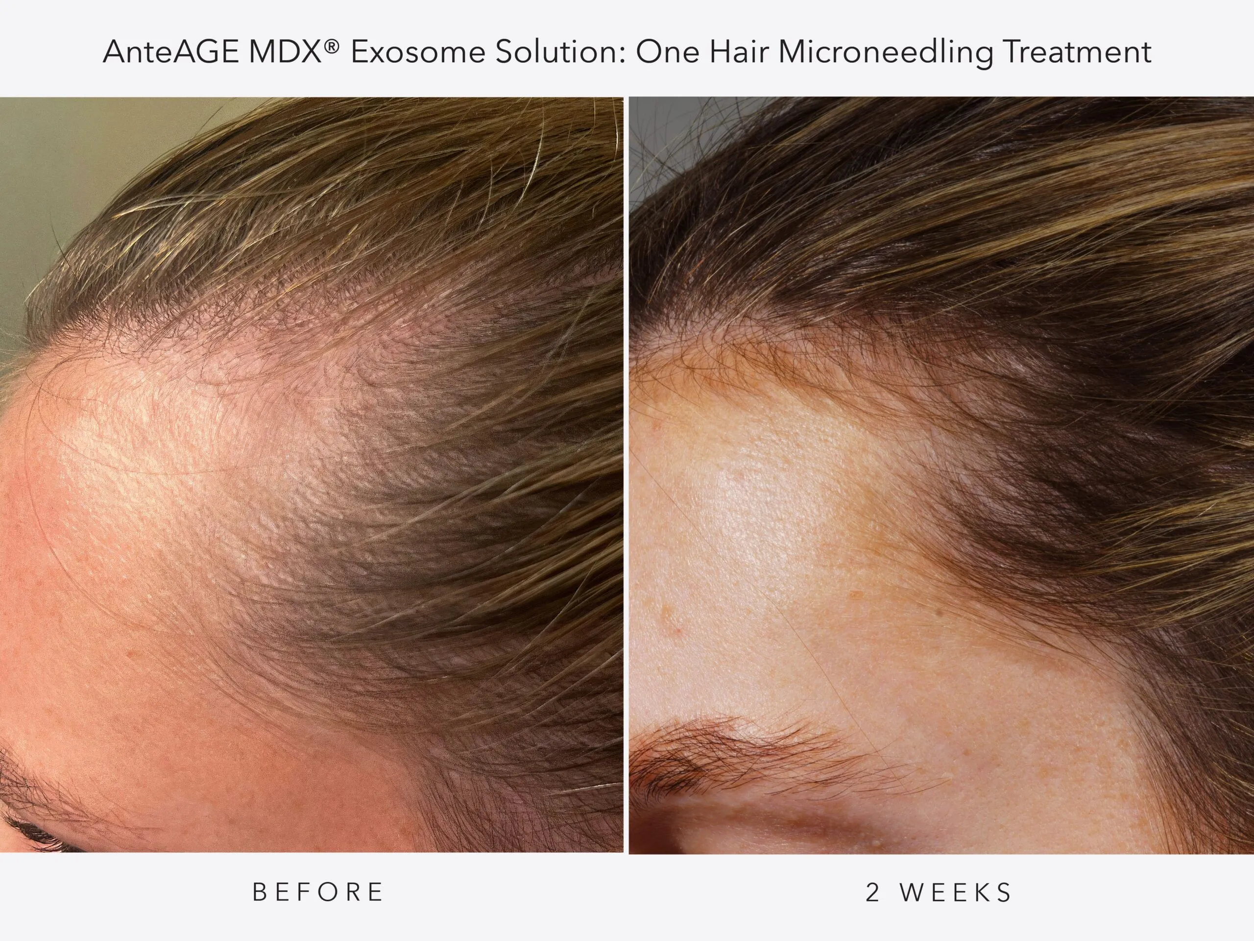 AnteAGE_MDX Hair BA_1A_Digital