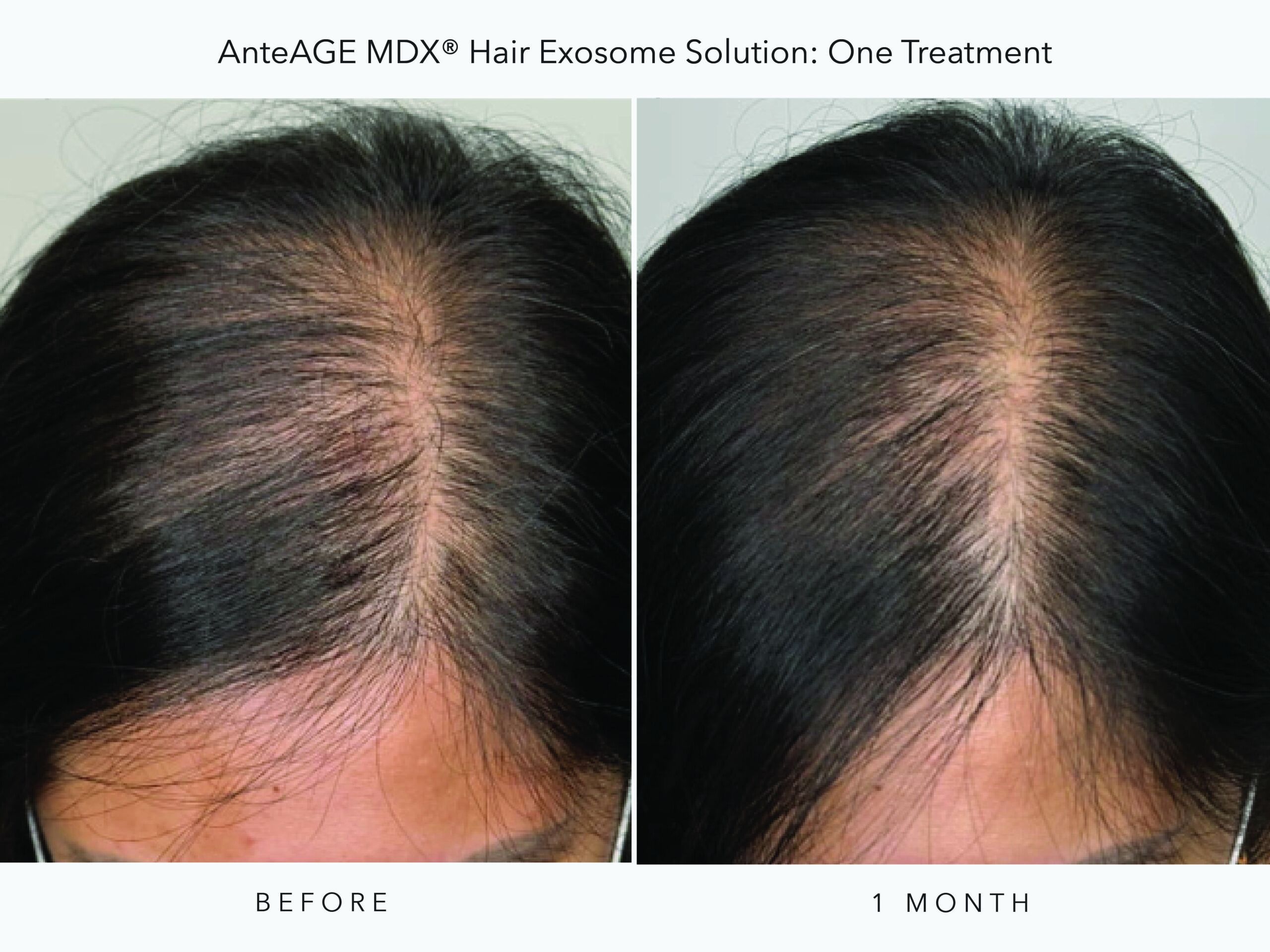 AnteAGE_MDX Hair BA_6A_Digital