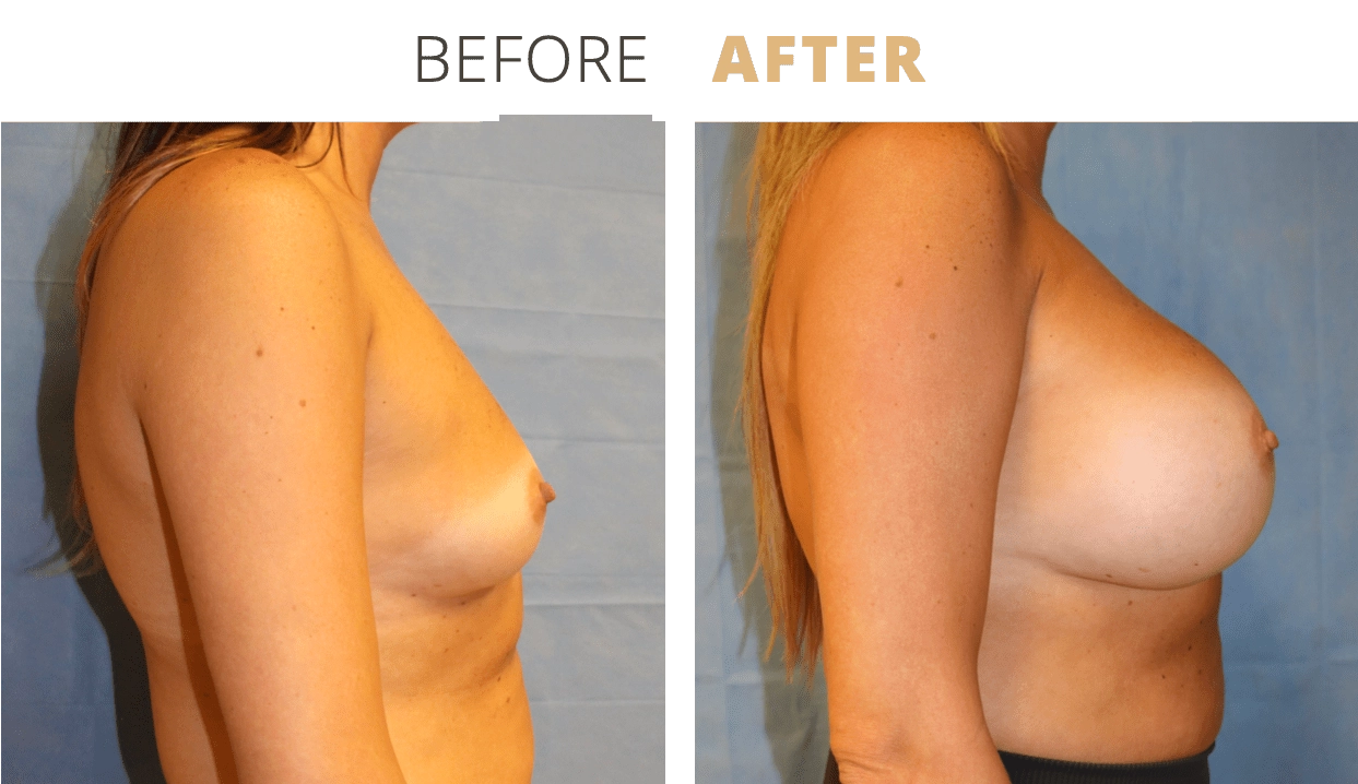Breast-BreastAugmentation10