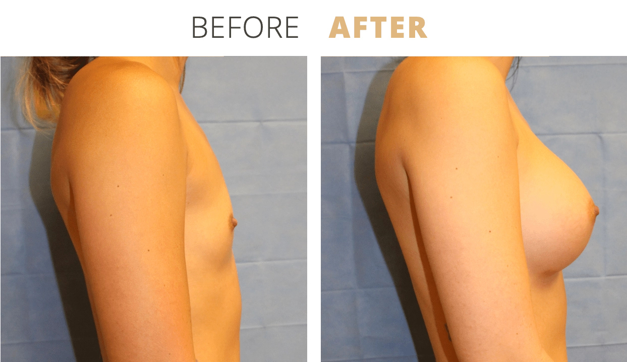 Breast-BreastAugmentation2