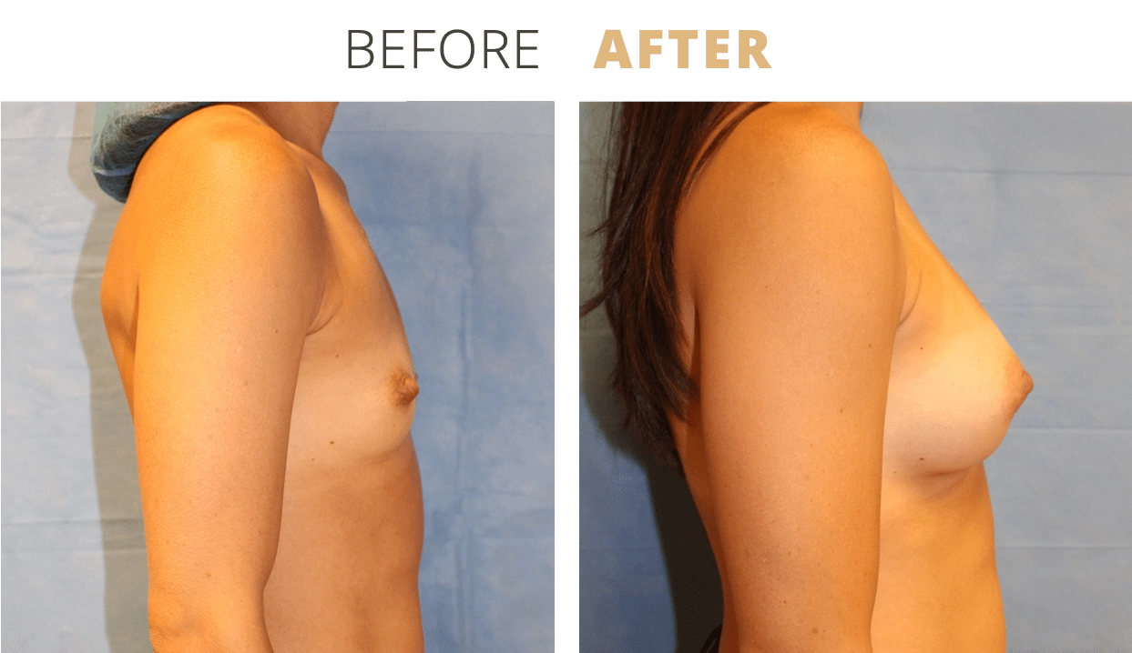 Breast-BreastAugmentation4