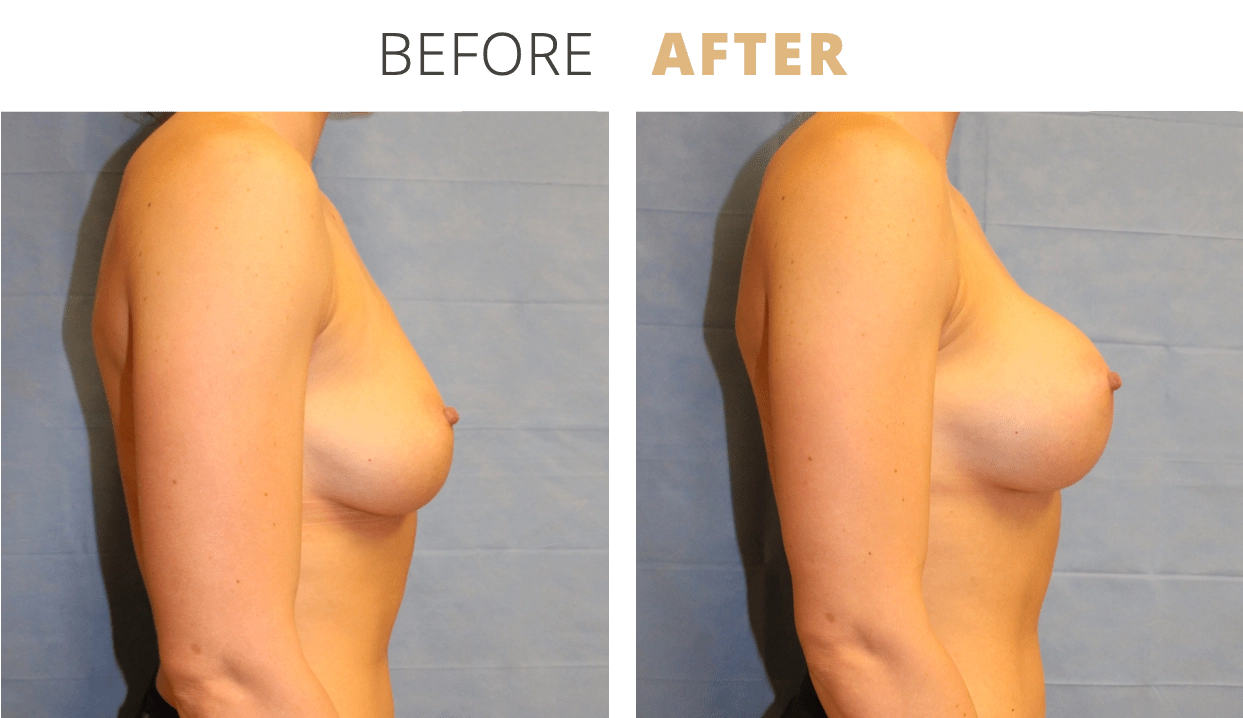 Breast-BreastAugmentation5