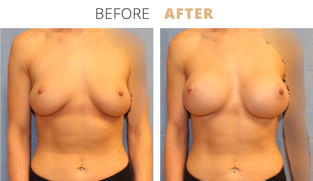 Breast-BreastAugmentation6