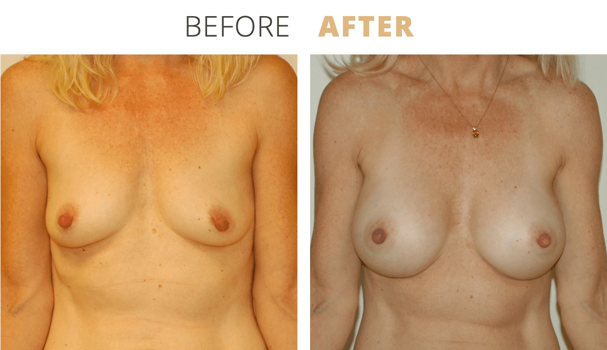 Breast-BreastAugmentation7