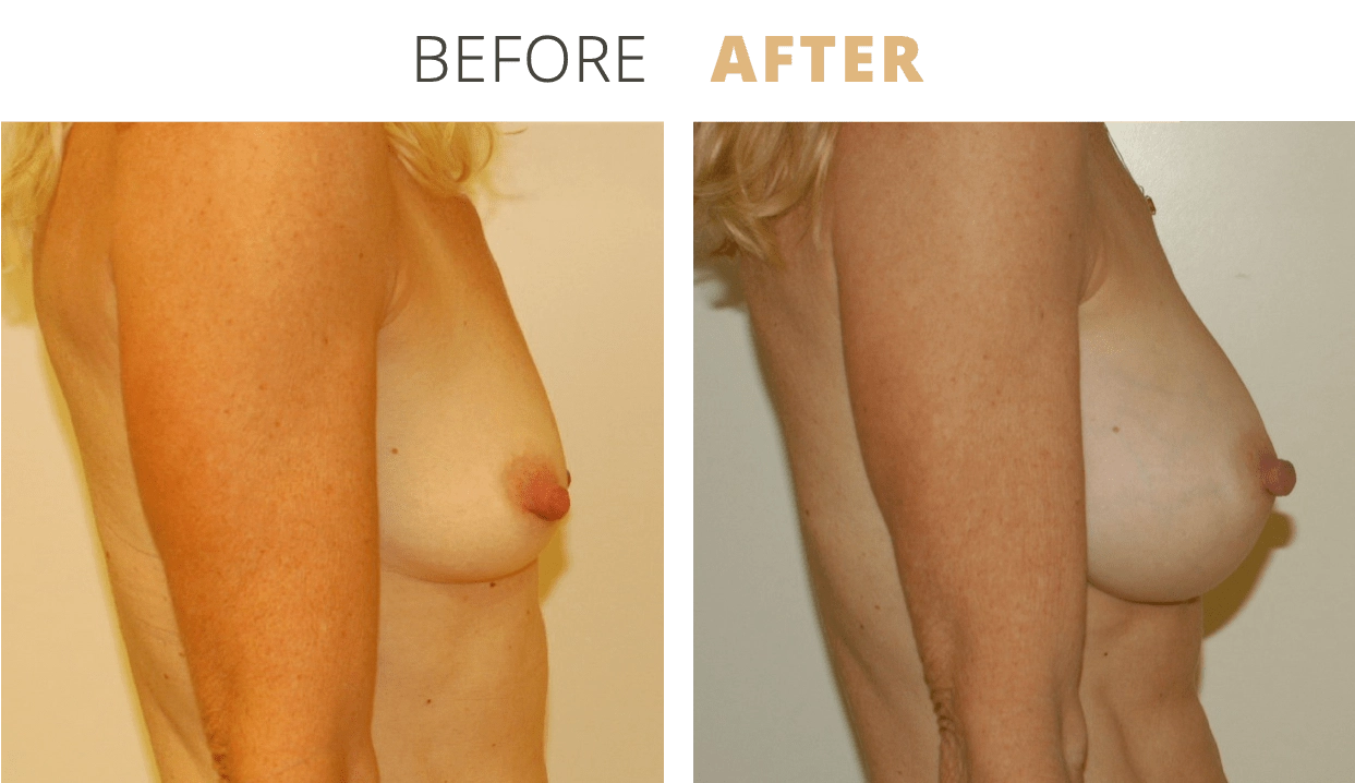 Breast-BreastAugmentation8