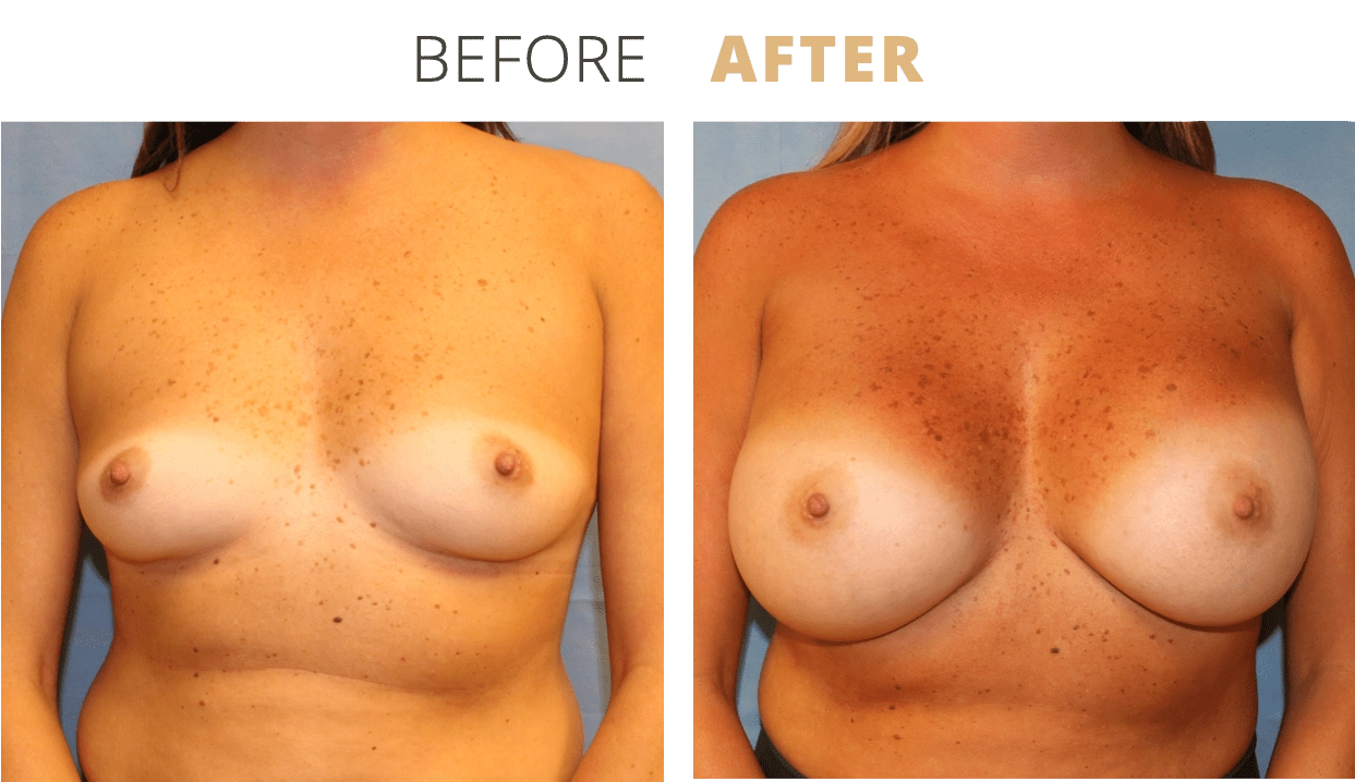 Breast-BreastAugmentation9