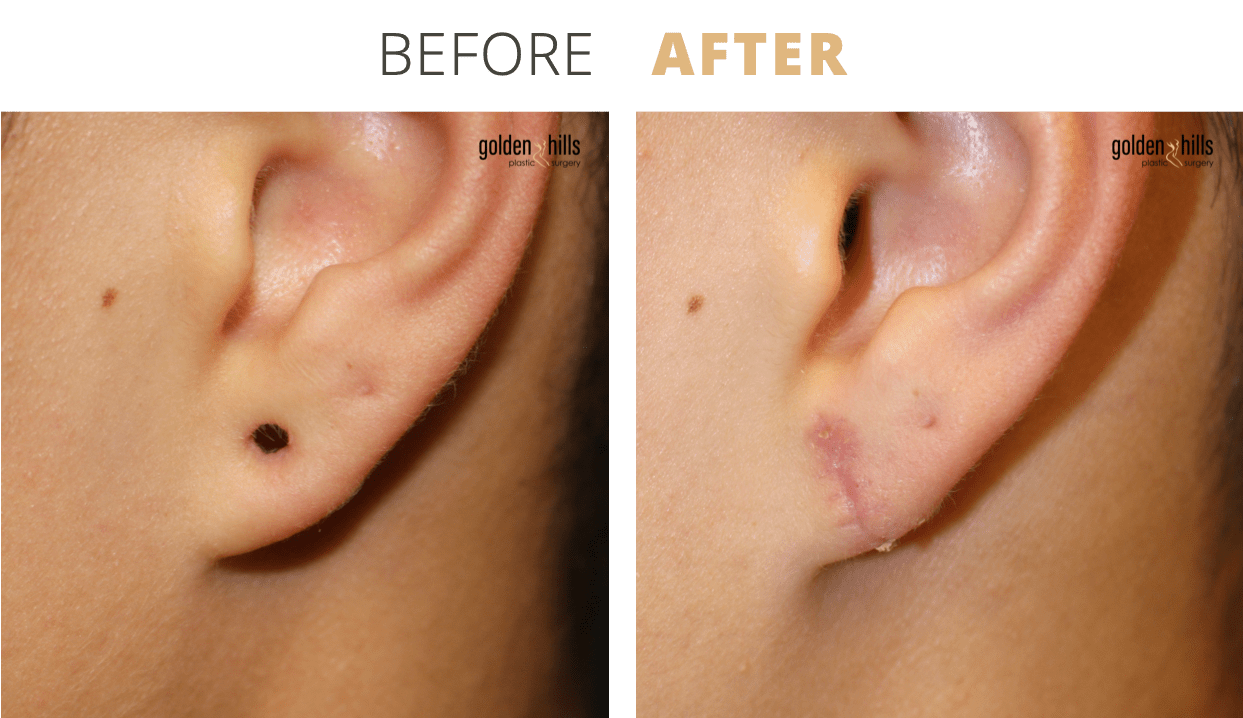 Face-Earlobe+Reconstruction1