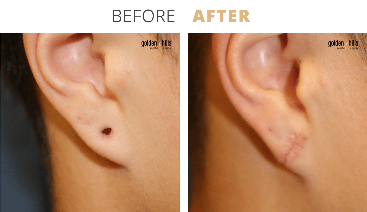Face-Earlobe+Reconstruction2