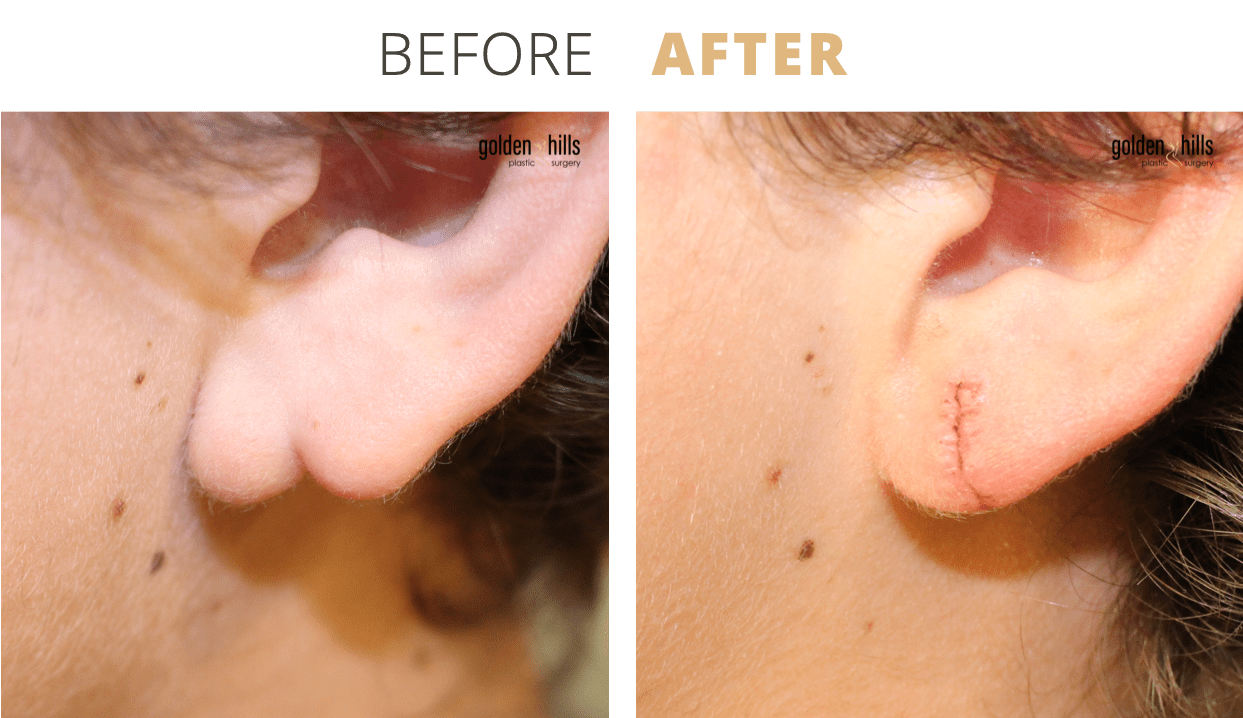 Face-Earlobe+Reconstruction3