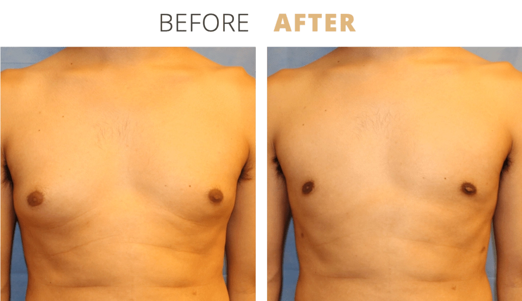 ForMen-MaleBreastReduction1-1024x591