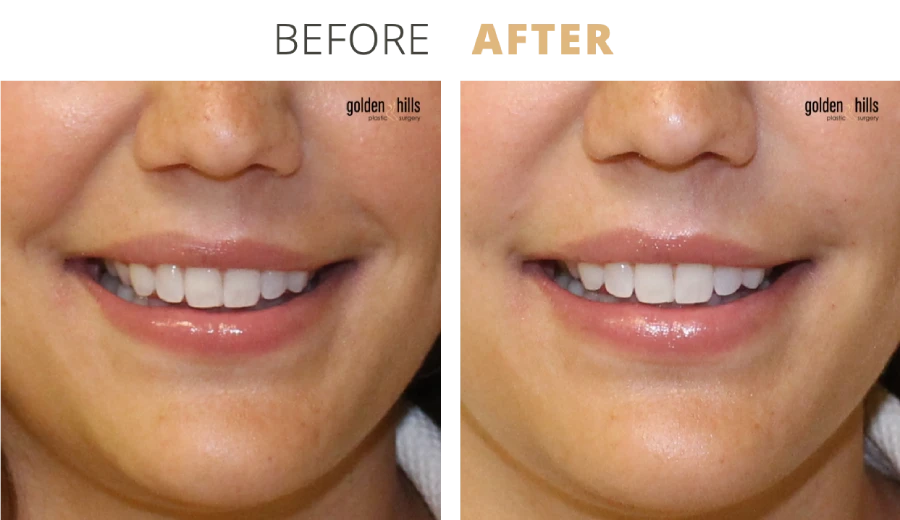 Injectables Facial Aging Repair, Nasolabial Fold