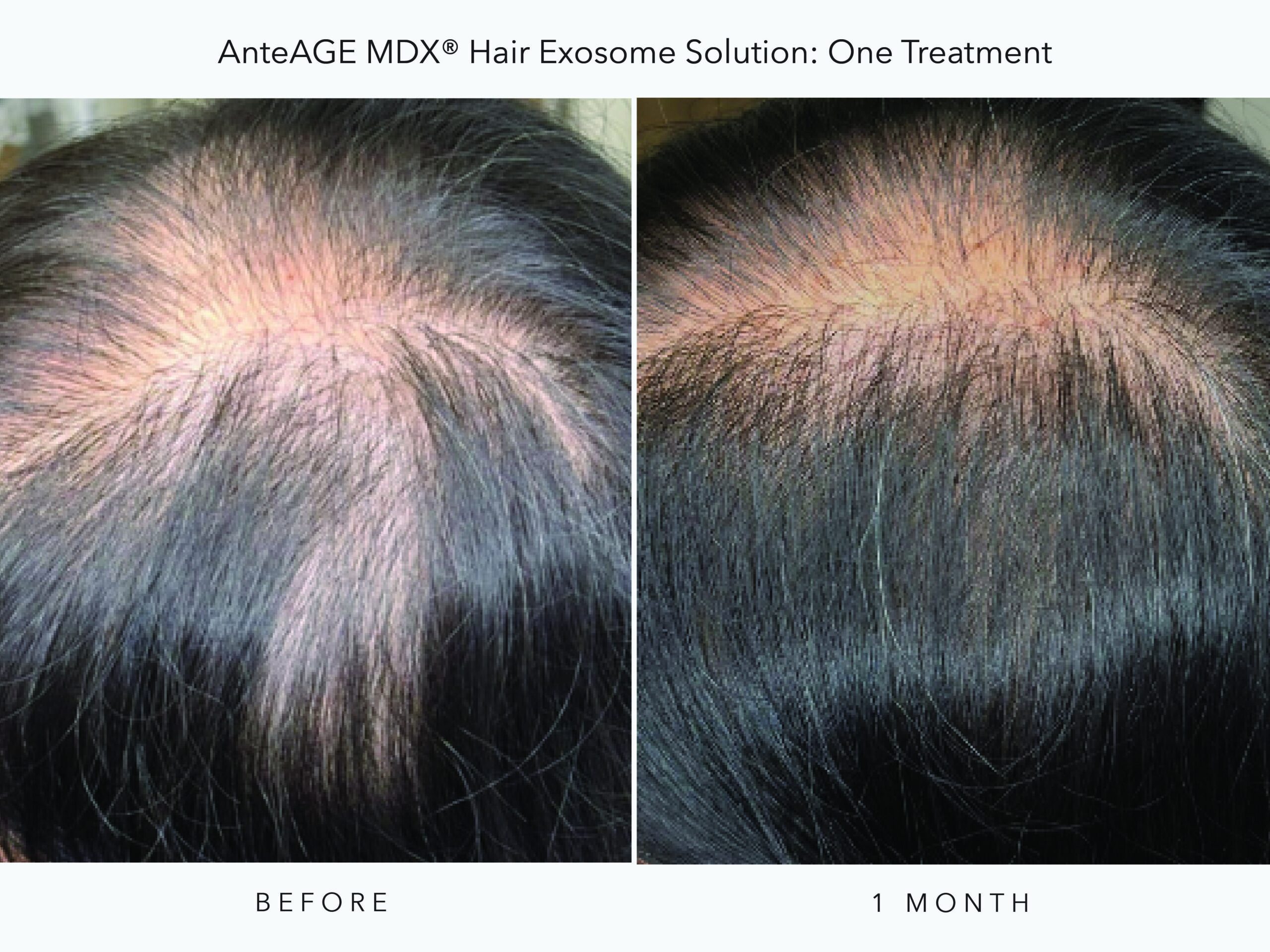 AnteAGE_MDX Hair BA_6B_Digital