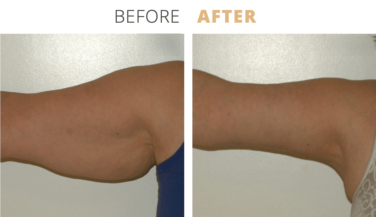 Body-ArmLiftBrachioplasty2-1