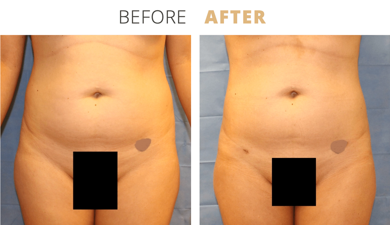 Body-Liposuction1