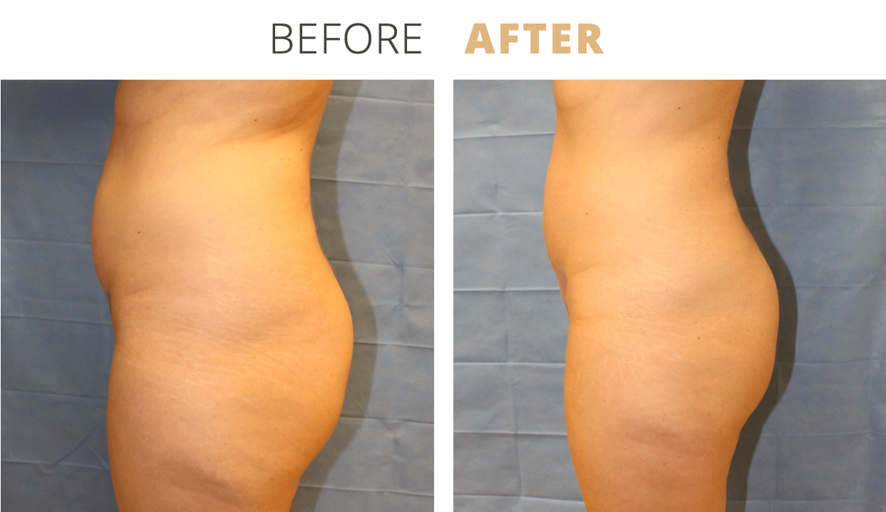 Body-Liposuction2