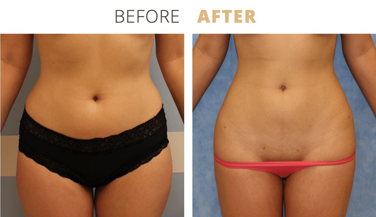 Body-Liposuction4