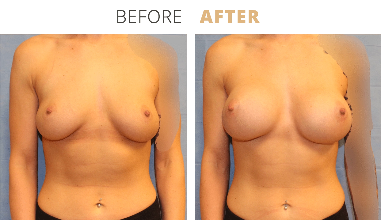 Breast-BreastAugmentation6