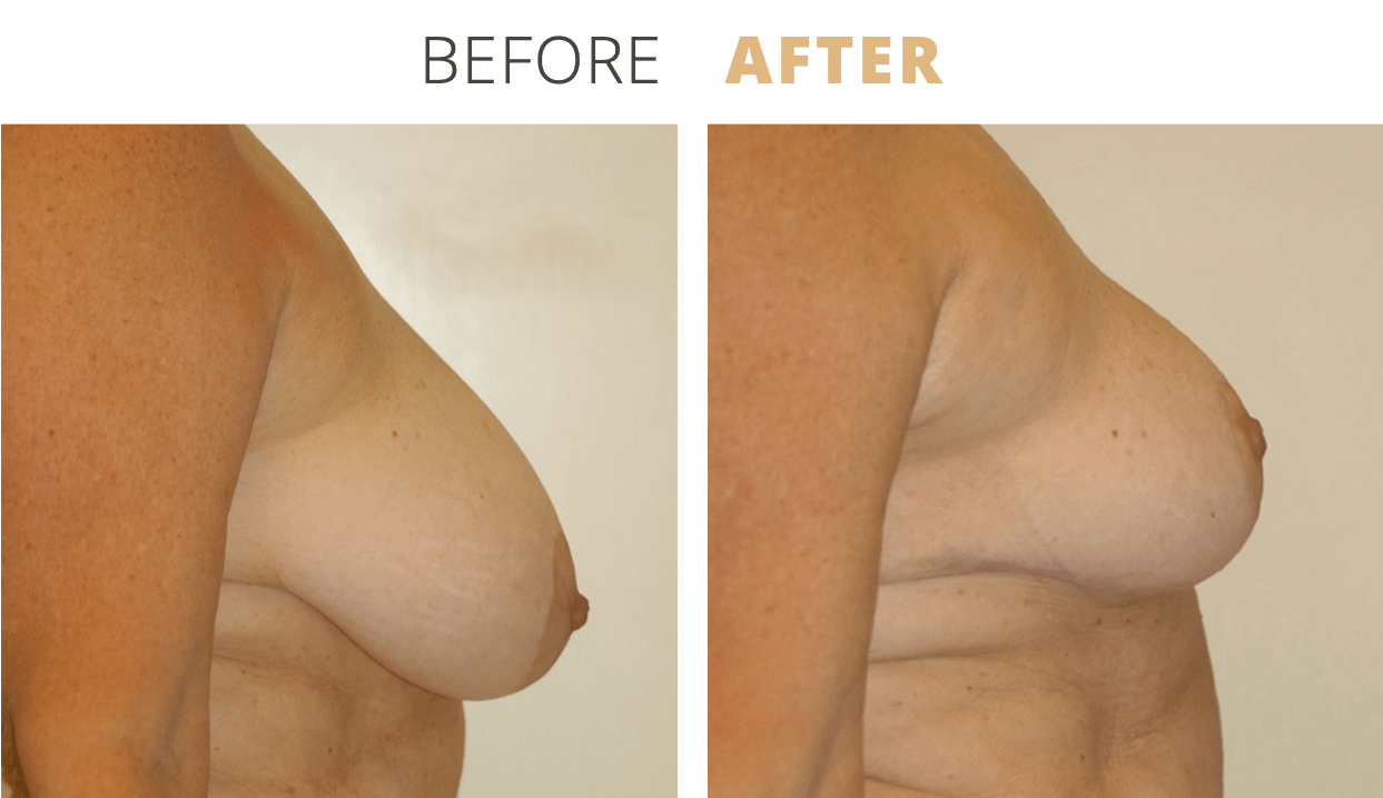 Breast-BreastReduction5
