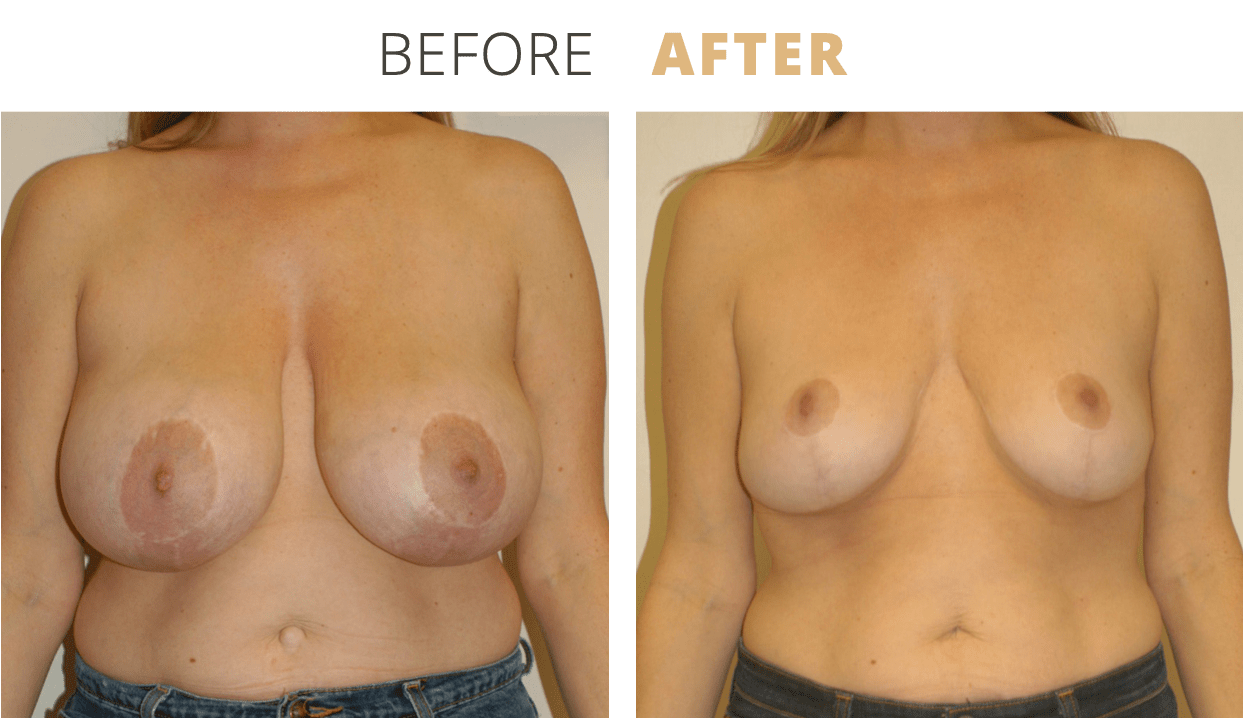 Breast-BreastReduction6