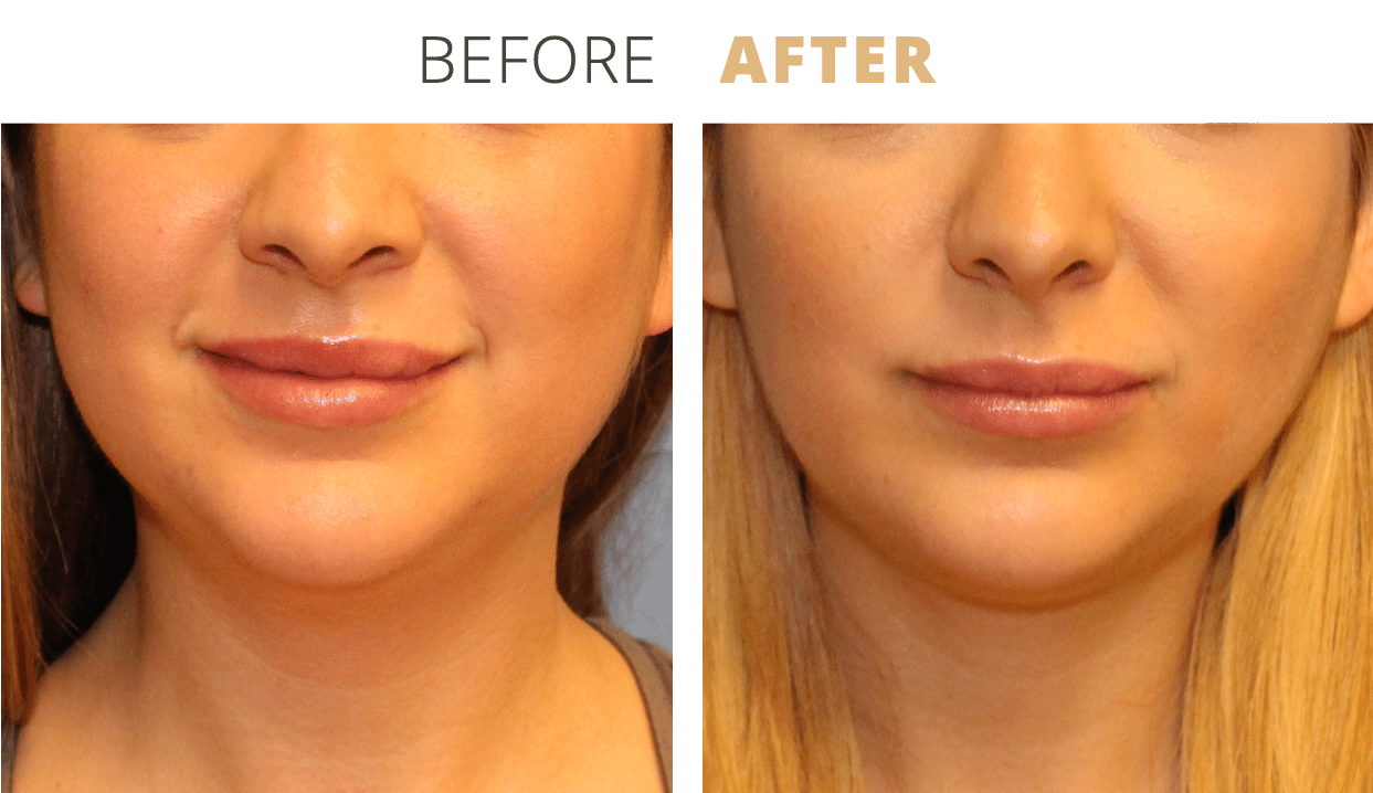 Face-BuccalFatPadRemoval1