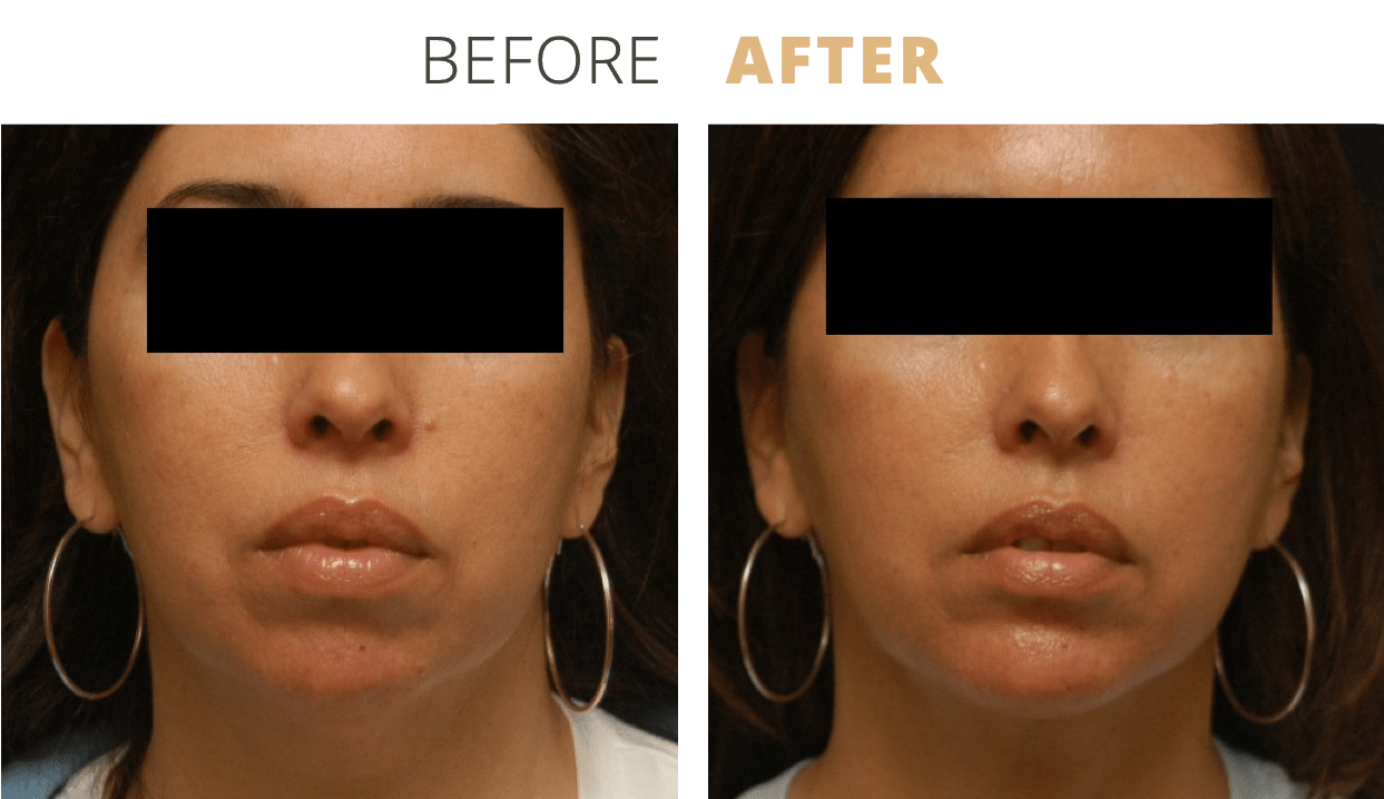 Face-ChinAugmentation1