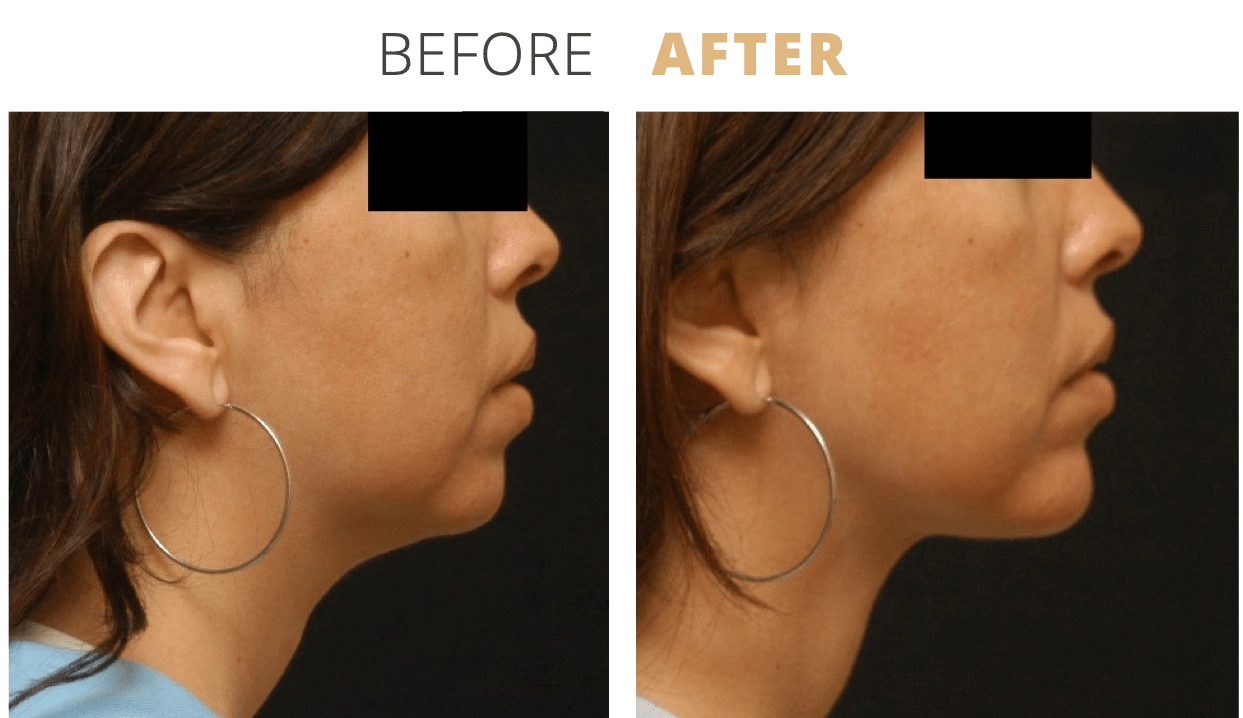 Face-ChinAugmentation2