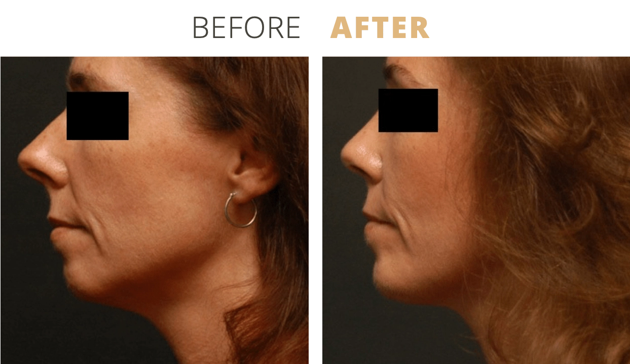 Face-ChinAugmentation3