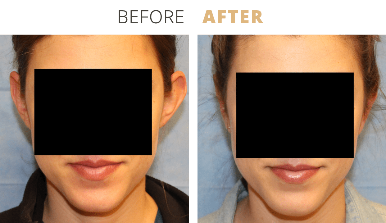 Face-EarSurgeryOtoplasty1