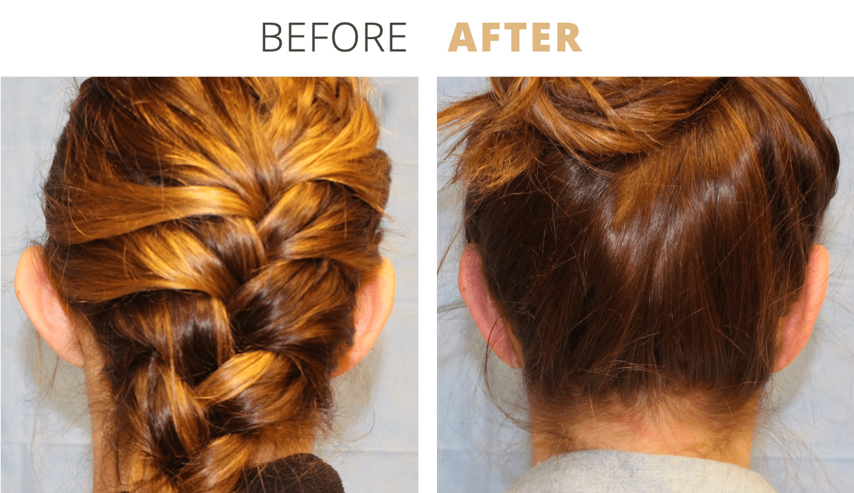 Face-EarSurgeryOtoplasty2