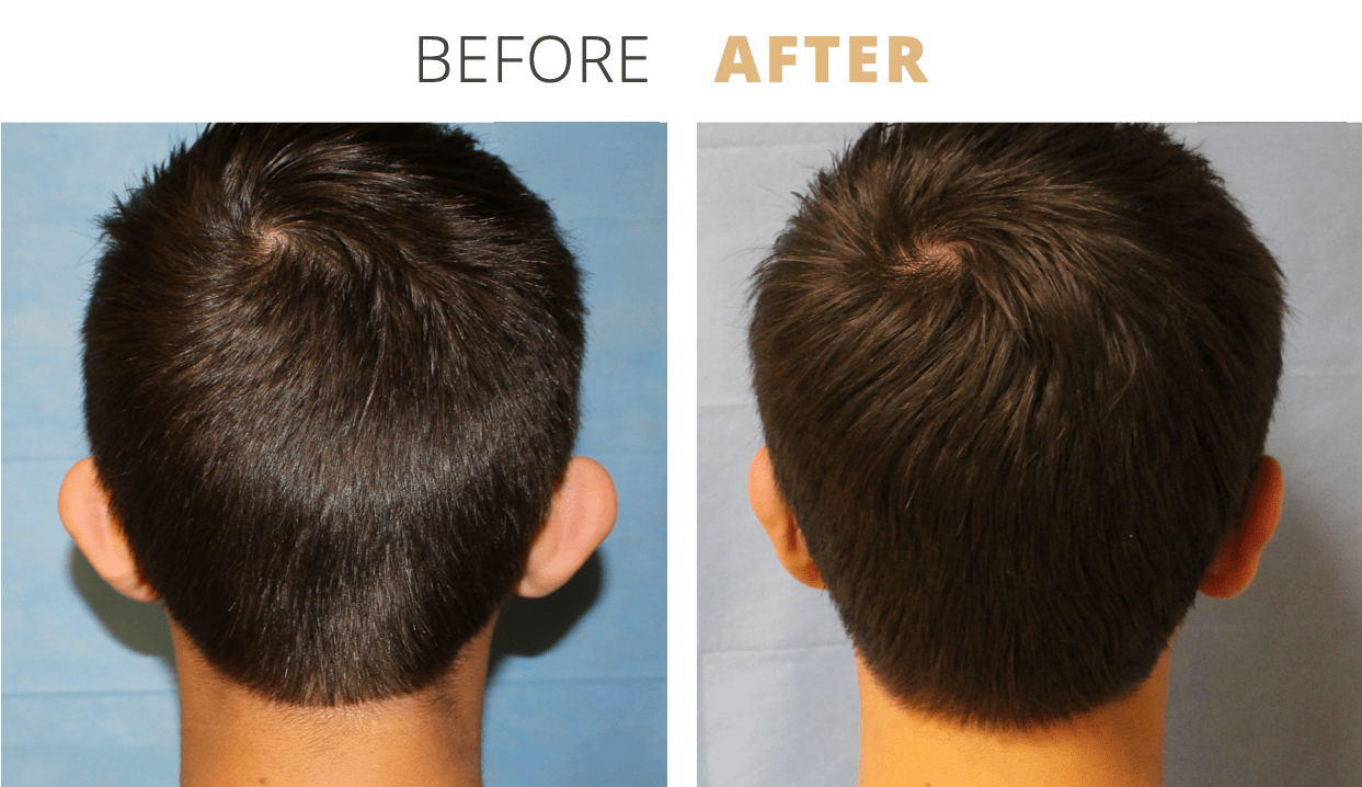 Face-EarSurgeryOtoplasty3