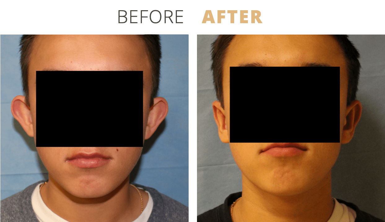 Face-EarSurgeryOtoplasty4