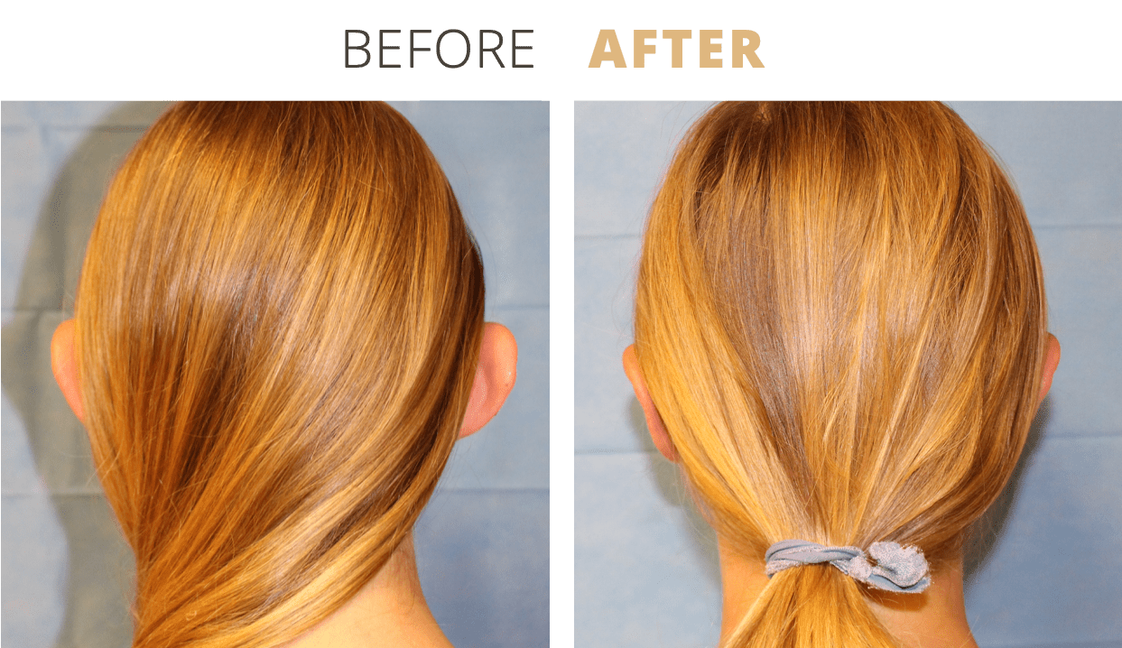 Face-EarSurgeryOtoplasty5